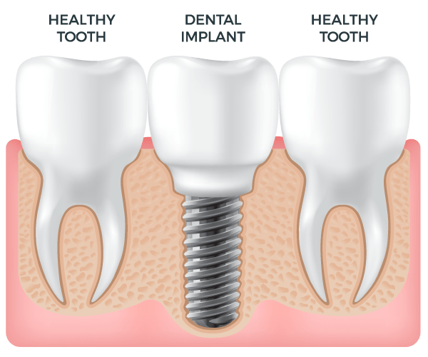 advantages of dental implants